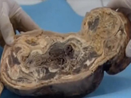 Thai hóa đá tồn tại 40 năm trong bụng cụ bà 82 tuổi