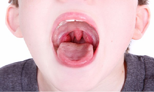 Bệnh viêm họng trắng và cách điều trị.
